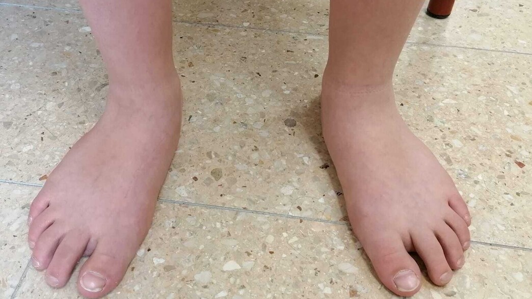 כפות רגליים שטוחות (צילום: באדיבות היחידה לאורתופדיה במרכז שניידר לרפואת ילדים מקבוצת כללית)