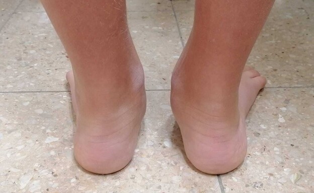 כפות רגליים שטוחות מאחור (צילום: באדיבות היחידה לאורתופדיה במרכז שניידר לרפואת ילדים מקבוצת כללית)