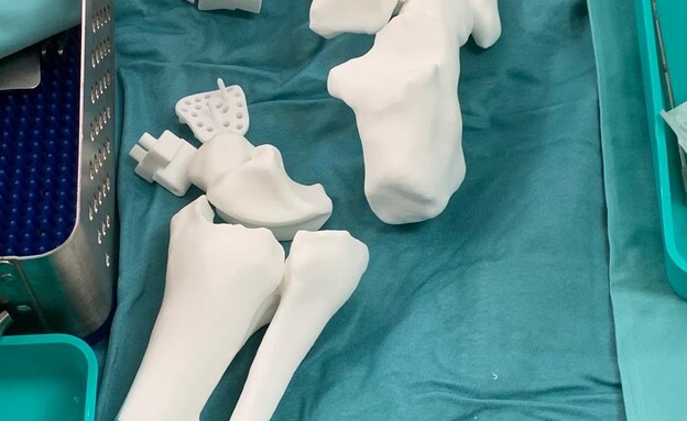Replacing an entire ankle joint using 3D printing in surgery