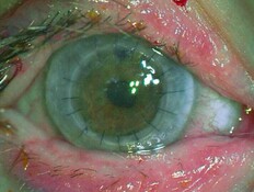 העין שבה הושתלה הקרנית (צילום: שערי צדק)