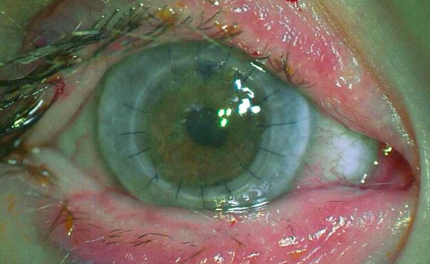 העין שבה הושתלה הקרנית (צילום: שערי צדק)