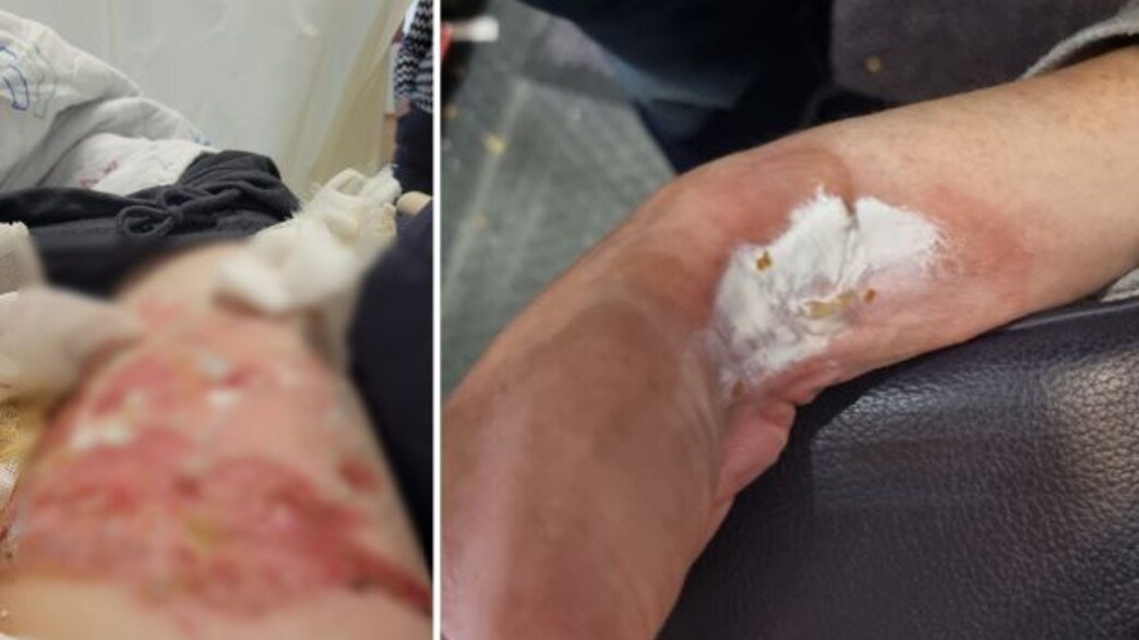 נוסעת כוויה ריינאייר נוסעת כוויה ריינאייר