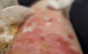 כוויה של נוסעת עם ריינאייר (צילום: פרטי)