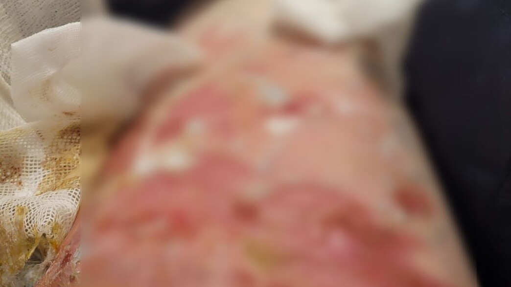 כוויה של נוסעת עם ריינאייר