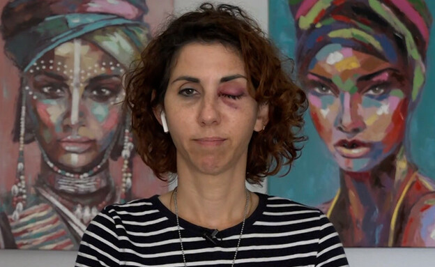 ד"ר טל וייסבאוך, נפצעה בעין ממכת"זית בהפגנה