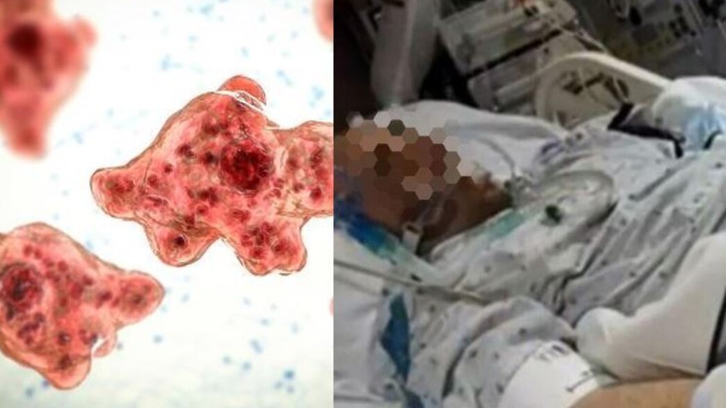 אמבה אוכלת מוח אמבה אוכלת מוח