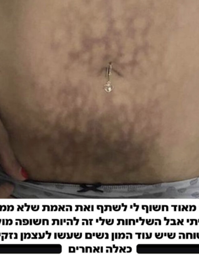 ספיר בורגיל על הצלקות בבטן (צילום: instagram)