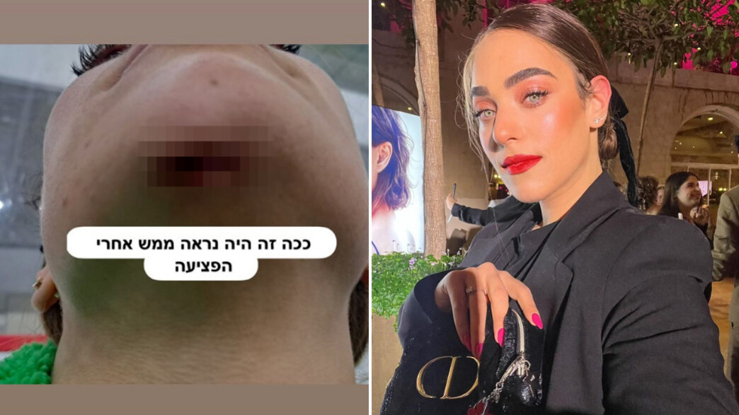 אסתי סוקולובסקי פצועה (צילום: מתוך האינסטגרם של אסתי סוקולובסקי)