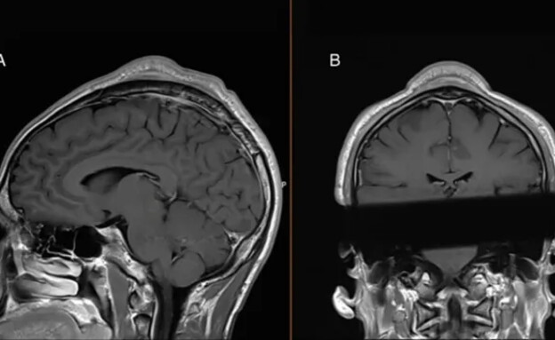 בליטה בראש בעקבות ברייקדאנס (צילום: BMJ Case Reports, odditycentral)