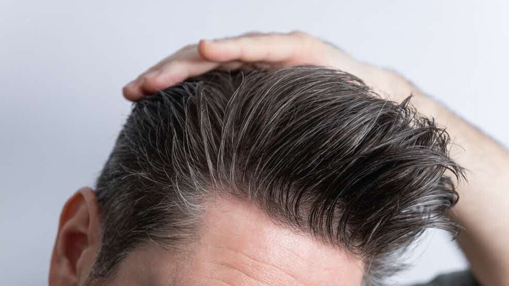 השתלות שיער השתלות שיער