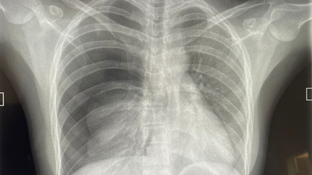 צילום הרנטגן שגילה את הבעיה