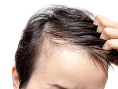 הדיאטה הפופולרית גורמת להתקרחות?  (צילום: 123rf)