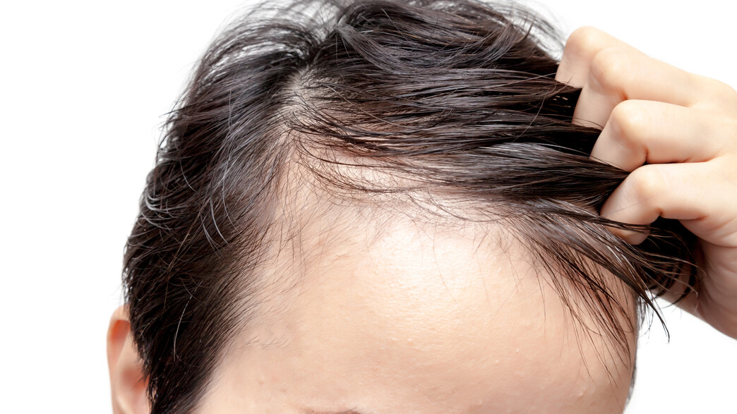 הדיאטה הפופולרית גורמת להתקרחות? 