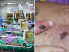 אבעבועות הקוף