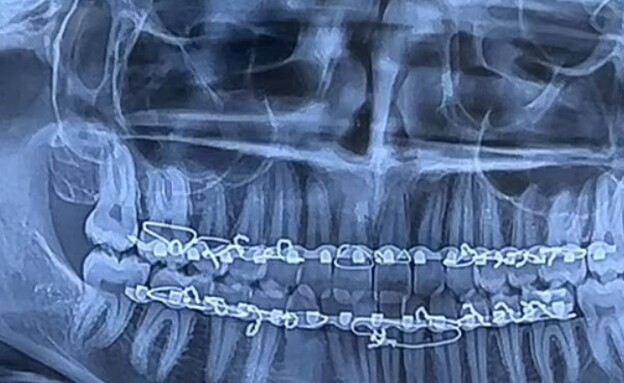 בת 19 אכלה סוכריית בולדוזר ושברה את הלסת שלה