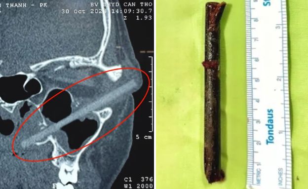 צ'ופסטיק (צילום: The Journal in Oral and Maxillofacial Surgery Cases )