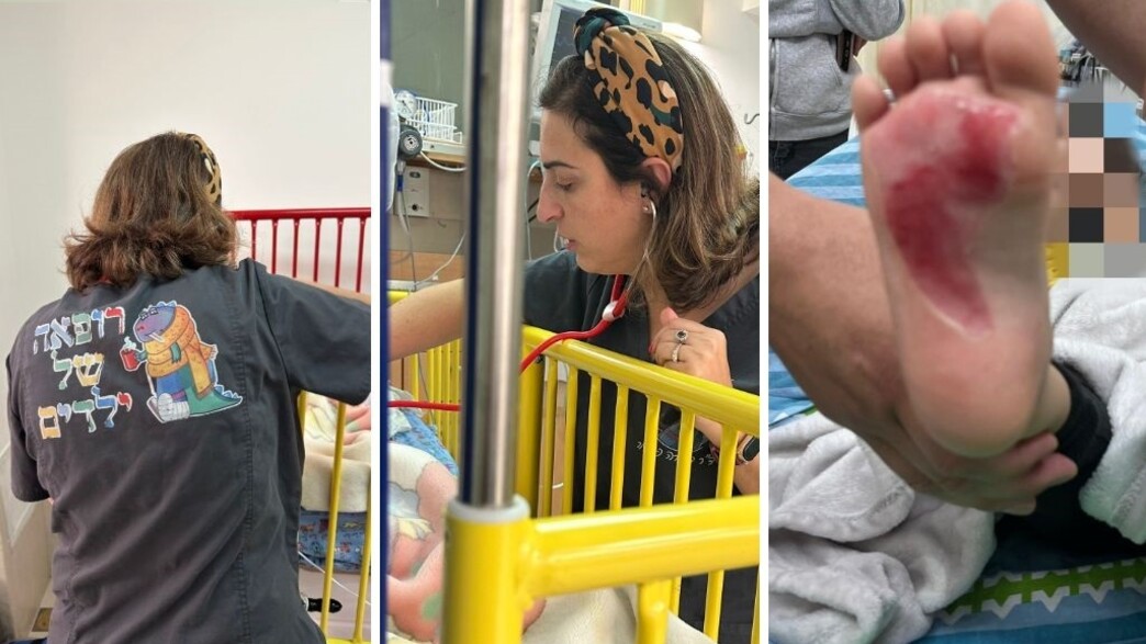 כוויות כוויות