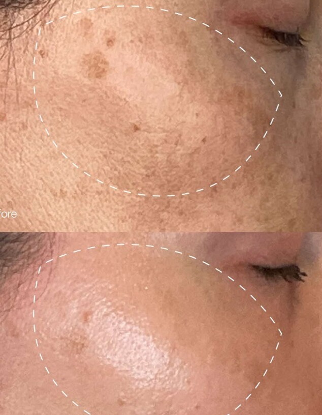 טיפול מלאנפורו טיפול מלאנפורו