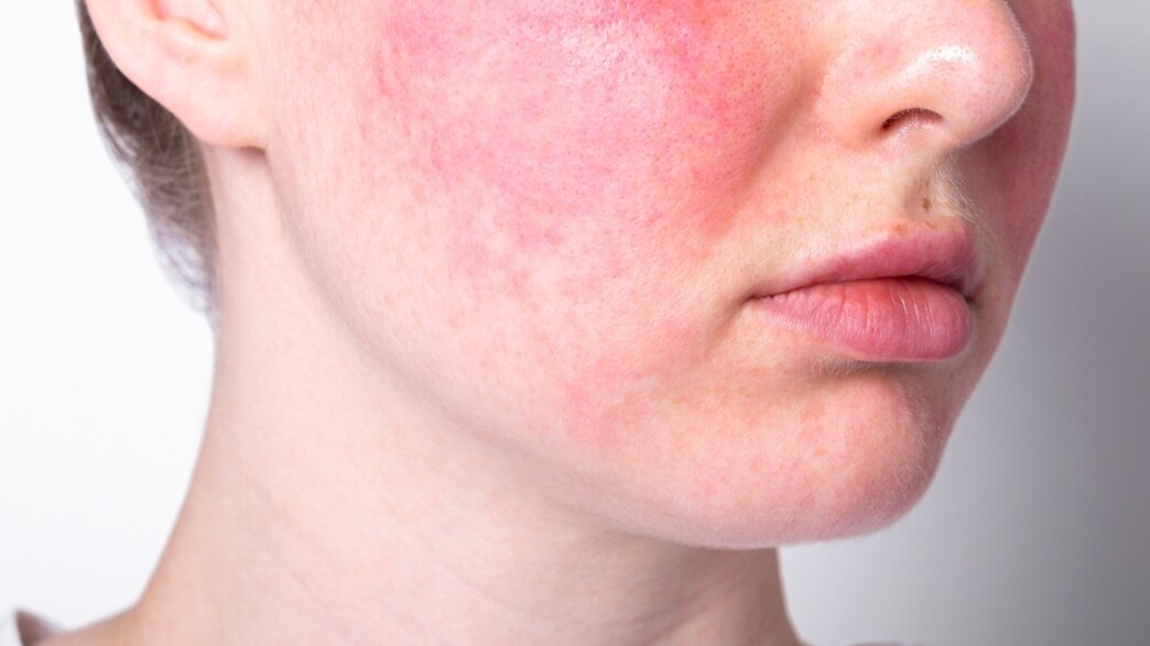 אדמומית בפנים אדמומית בפנים