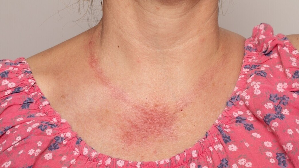 תגובה עורית, אדמומית, גירוי בעור תגובה עורית, אדמומית, גירוי בעור