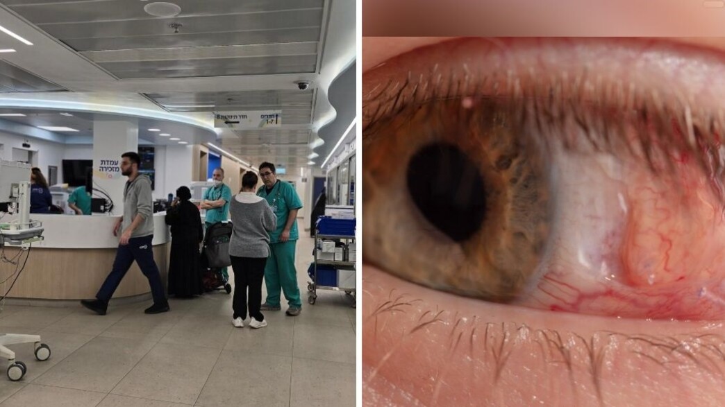 הפגיעה בעיניים