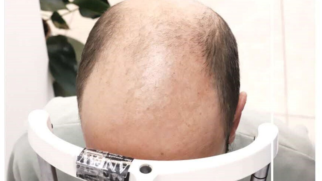 מיכאל - לקוח הייר מדיקל