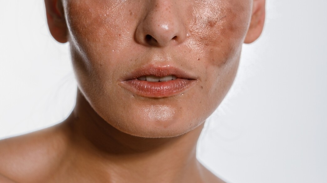 היפרפגמינטציה