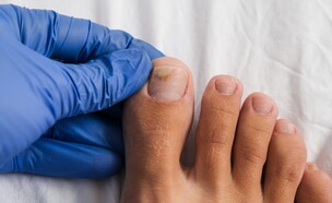 אמטריקס פטרת ציפורניים (צילום: ReaLiia, shutterstock)