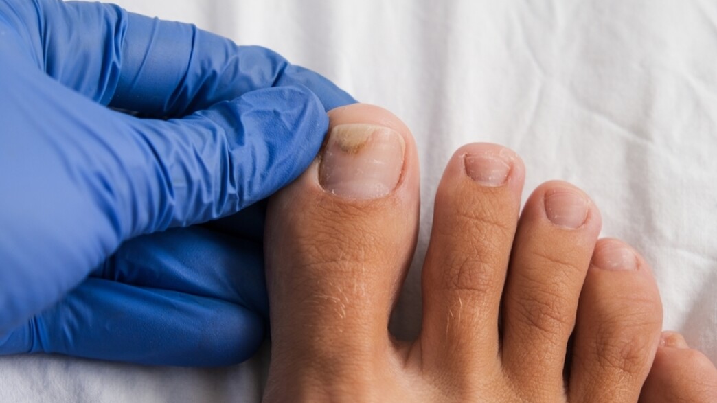 אמטריקס פטרת ציפורניים אמטריקס פטרת ציפורניים