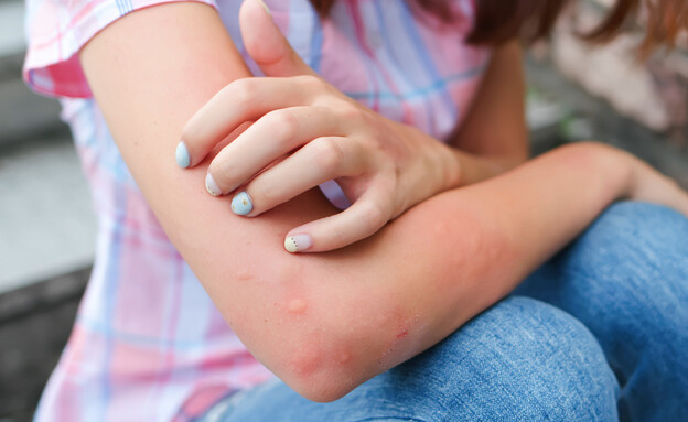 עקיצת יתוש (צילום: shutterstock_aslysun) עקיצת יתוש (צילום: shutterstock_aslysun)