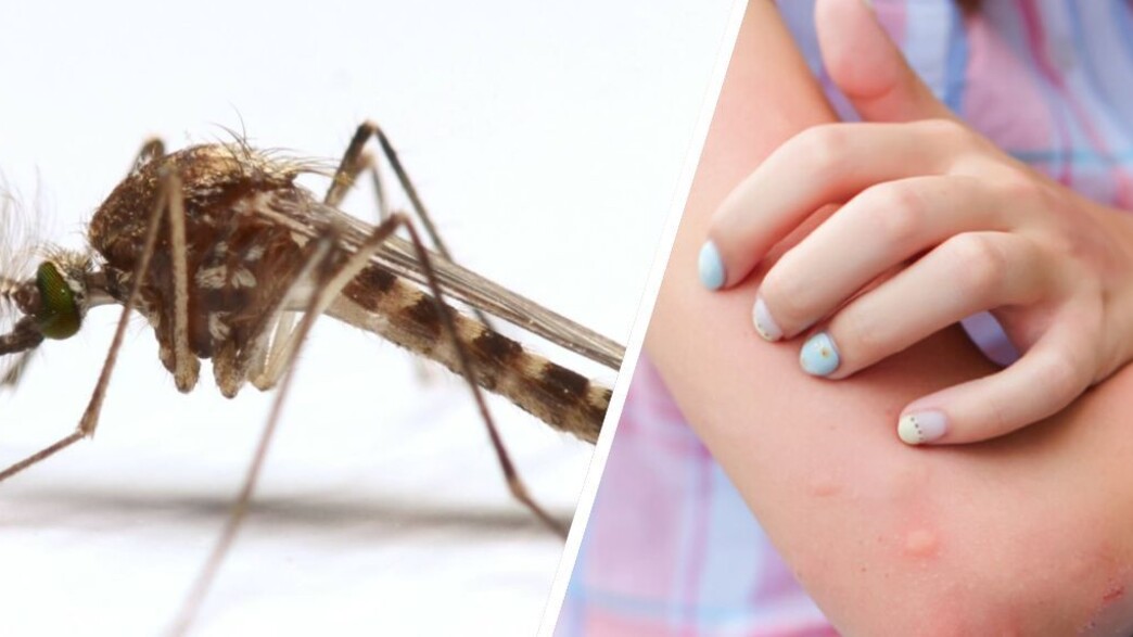 עקיצת יתוש עקיצת יתוש