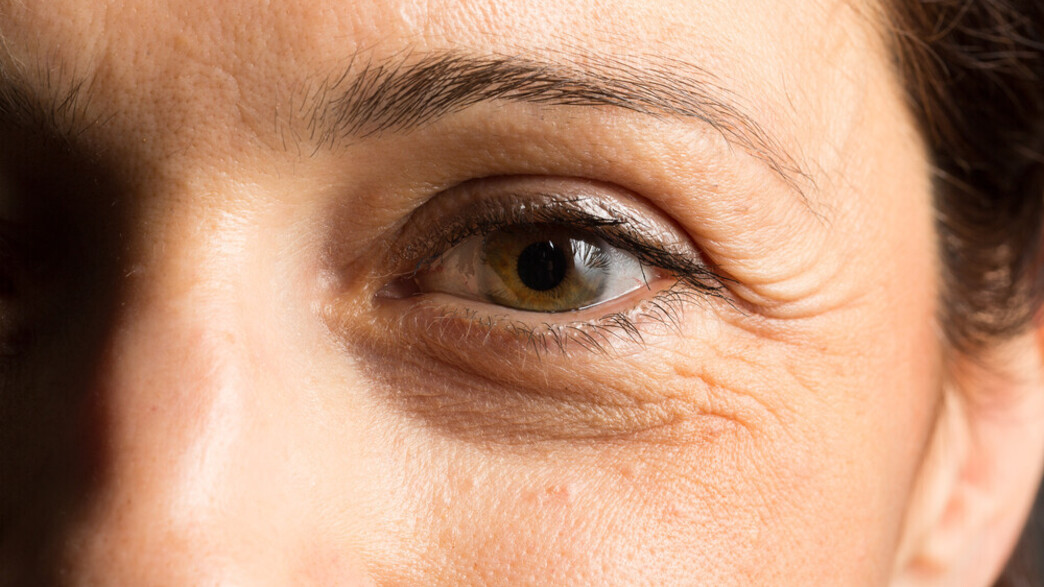 עיניים קלוז אפ, עיגולים שחורים סביב העיניים עיניים קלוז אפ, עיגולים שחורים סביב העיניים