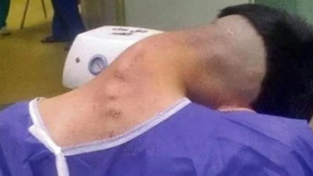 תסמונת הראש השמוט