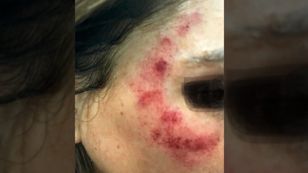 הגיעה לטיפול לייזר בפנים ויצאה כוויות