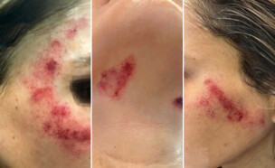 הגיעה לטיפול לייזר בפנים ויצאה כוויות (עיבוד: ללא)