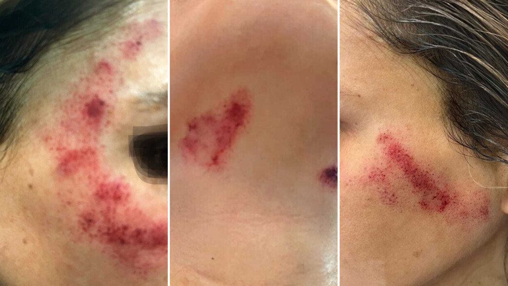 הגיעה לטיפול לייזר בפנים ויצאה כוויות