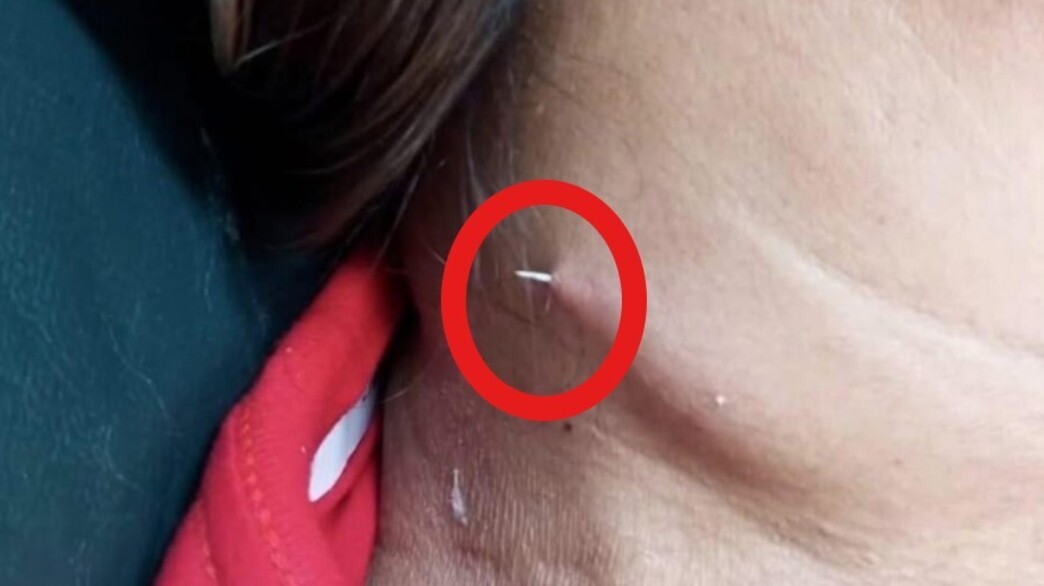 חרדה בתאילנד: שתתה מרק דגים ובלעה עצם של דג - שנתקעה בצווארה