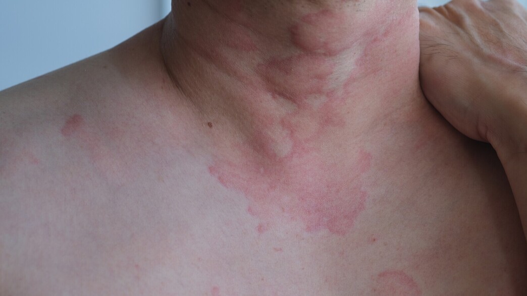 מחלת עור קשה מחלת עור קשה