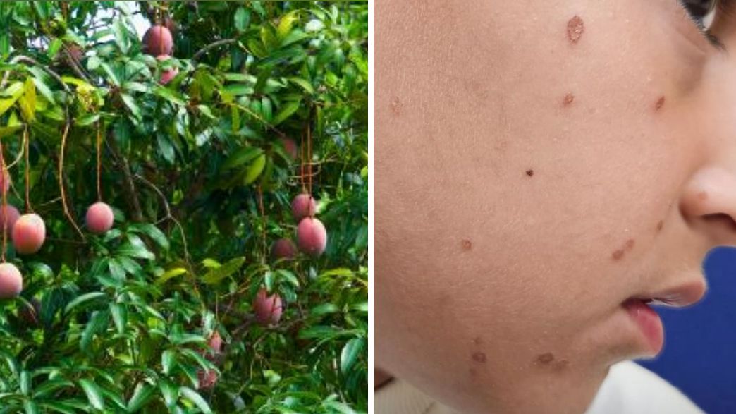 ילד נכווה מעץ מנגו