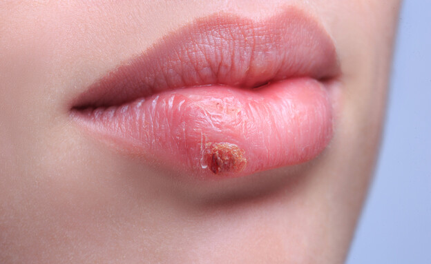 הרפס (צילום: Kopytin Georgy, Shutterstock)