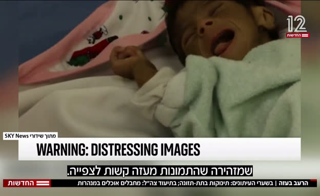 הרעב בעזה: תינוקת בתת-תזונה בשערי העיתונים