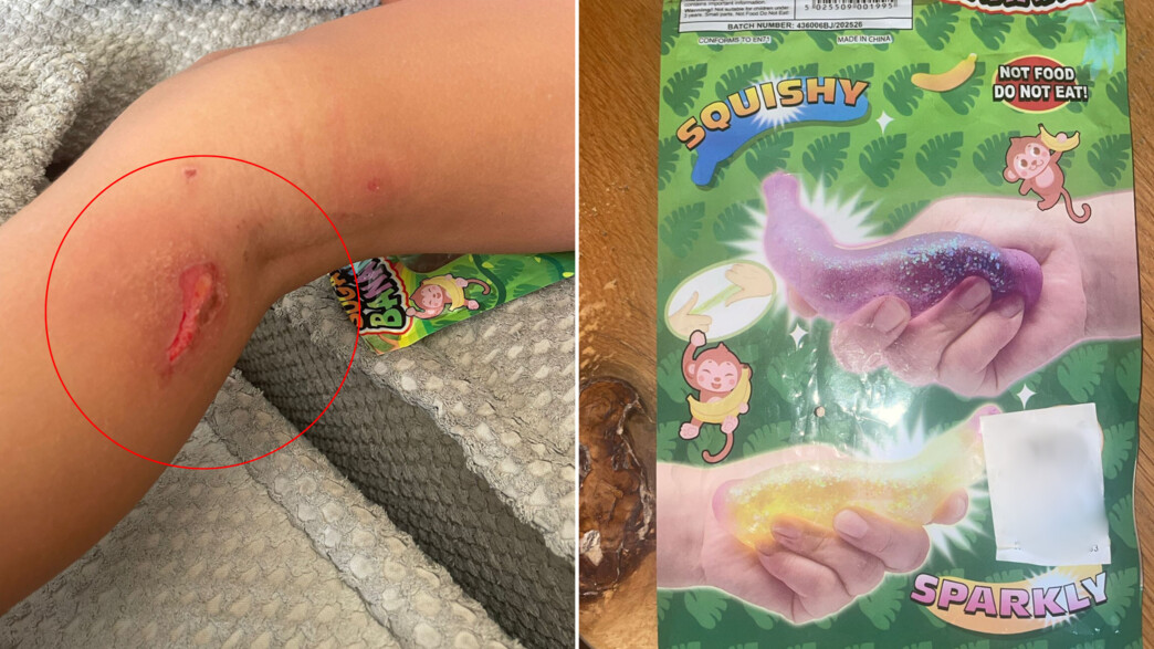 הכוויות של הילדה ליאן שנגרמו ממשחק ב"סקוושי"