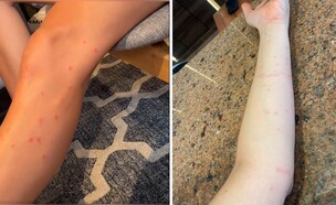 העקיצות על גופם של הנופשים