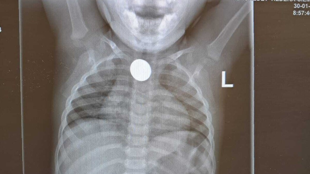 ילד שבלע מטבע של חצי שקל ילד שבלע מטבע של חצי שקל