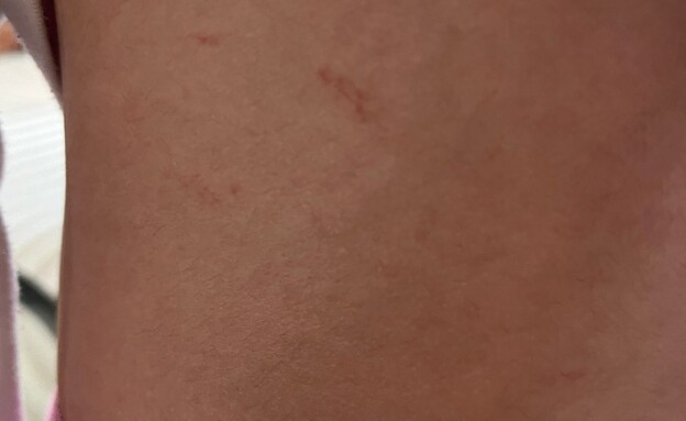 עקיצות בפארק המים עקיצות בפארק המים