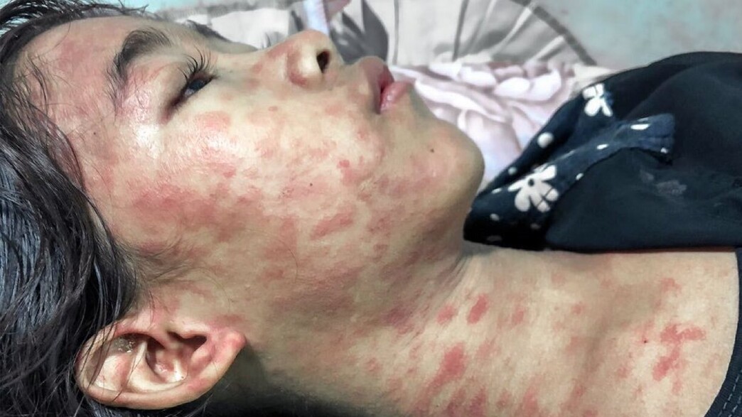 סין מתמודדת עם נגיף הצ'יקונגוניה סין מתמודדת עם נגיף הצ'יקונגוניה