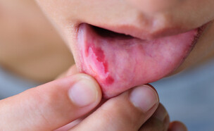 כתם בשפתיים (צילום: SHUTTERSTOCK)