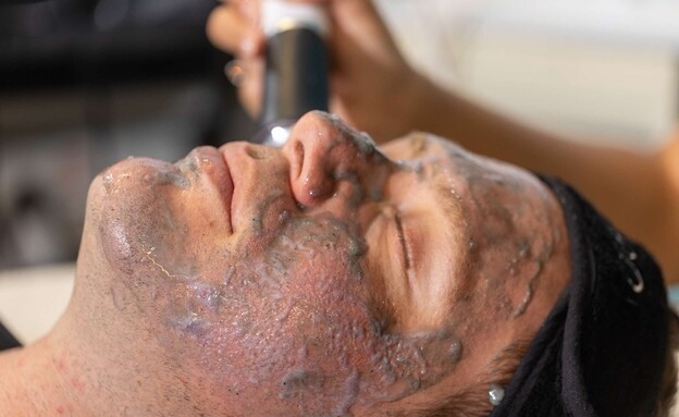 טיפול GENEO טיפול GENEO