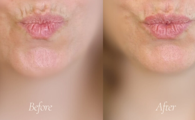 טיפול המבוצע ע"י ד"ר מתן וייס לאלונה שכטר טיפול המבוצע ע"י ד"ר מתן וייס לאלונה שכטר