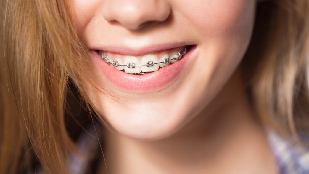 גשר בשיניים גשר בשיניים